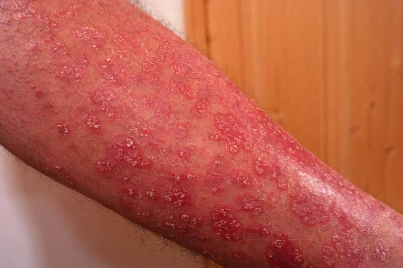 Psoriasis-These-Tips-Can-Help-Fix-It!