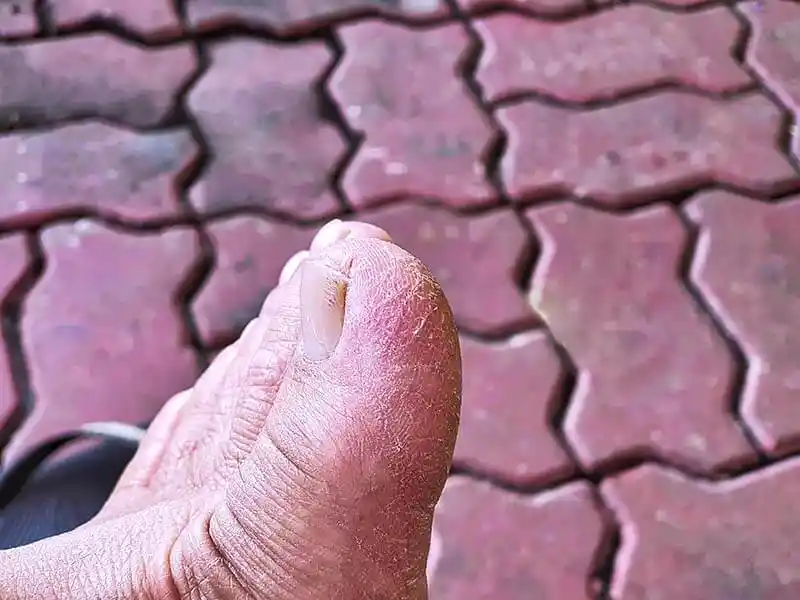 Fungal-nail-infection