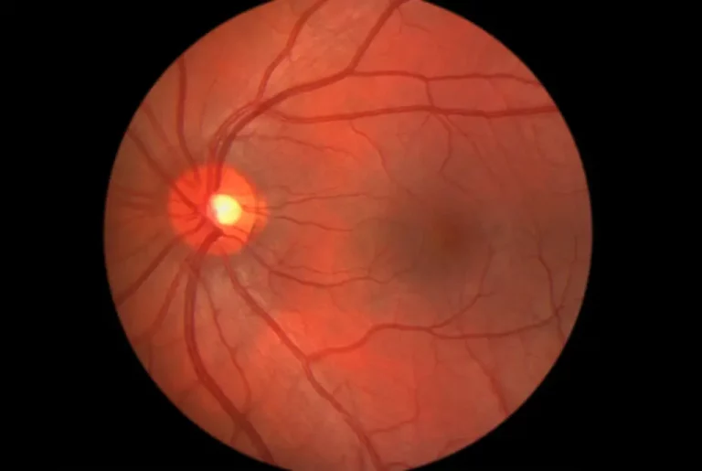 A Game-Changer-for-Macular-Degeneration-The-Promising-New-Cure
