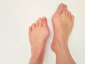 Bust-Your-Bunions-Effective-Strategies-for-Correcting-Foot-Deformities