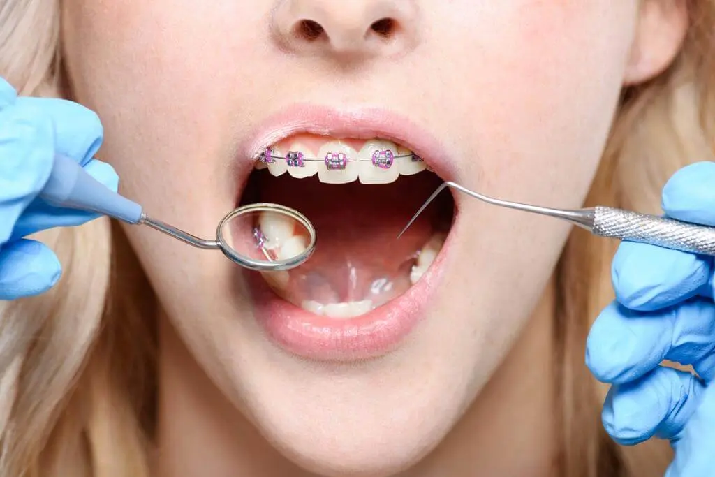 periodontal-probe