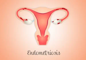 Signs-You-Might-Have-Endometriosis-Are-You-Affected