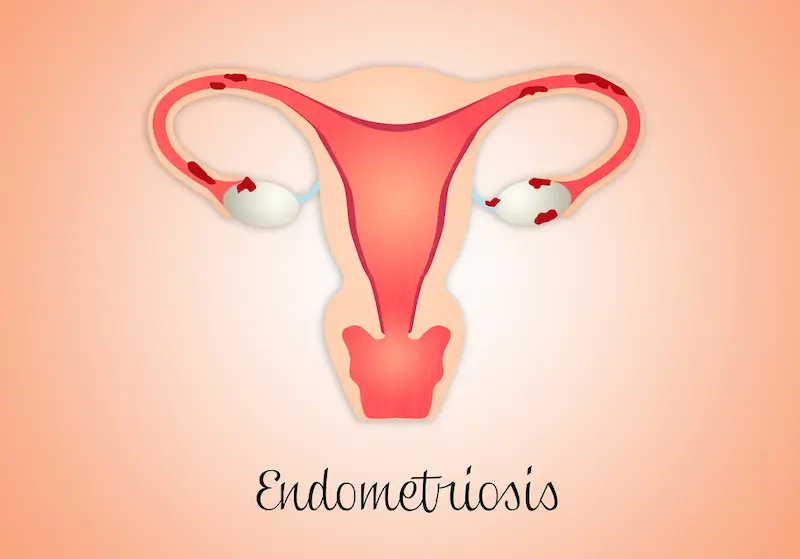 Signs You Might Have Endometriosis: Are You Affected?